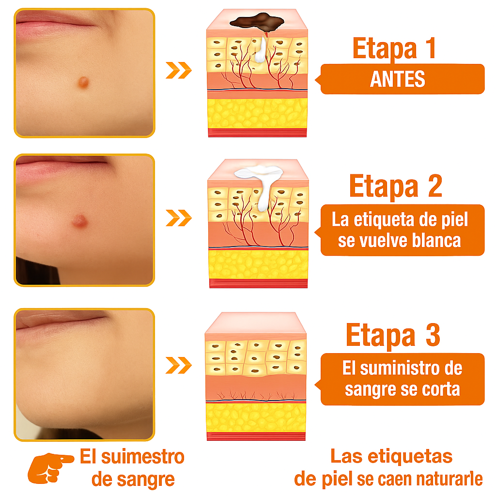 TagRecede - Eliminador de verrugas