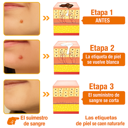 TagRecede - Eliminador de verrugas